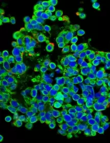 Blue and green metastatic carcinoma cells.