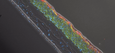 Ker-ct filiggrin epithelial cells.