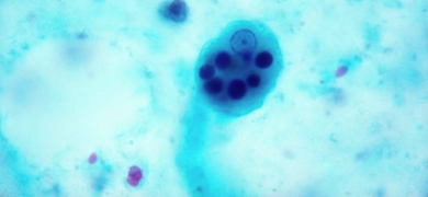 Microscopic image shows a parasitic Entamoeba histolytica trophozoite with one visible nucleus and six ingested red blood cells.