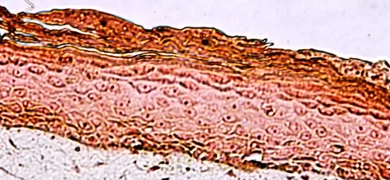 Red melanocyte cells.