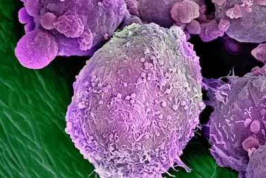 85757796[3] Lymphoma cancer cell re-colored.jpg