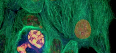 Breast cancer cells.