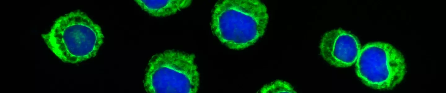 Fluorescent blue and green spheres of leukemic cells.