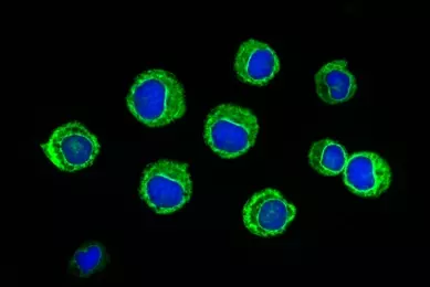 Fluorescent blue and green spheres of leukemic cells.