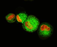 Leukemic cells labeled with fluorescent molecules