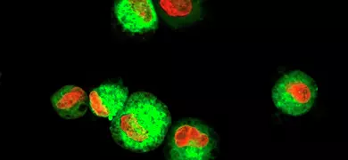 Leukemic cells labeled with fluorescent molecules