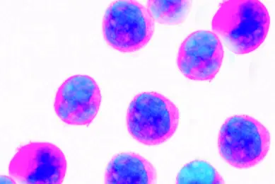 Fluorescently labeled leukemic cells under a microscope, shown in vivid blue and pink colors on a white background.