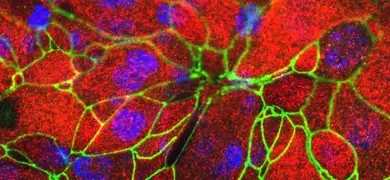 Red and green human papillary adenocarcinoma cells.