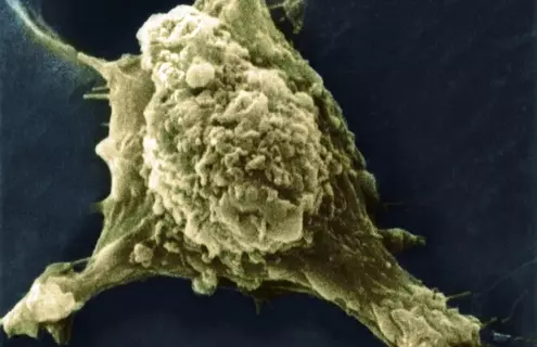 F0010662_Metastasis Melanoma cell line_showing pseudopodia protrusion, prominent feature of actively motile cells.JPG