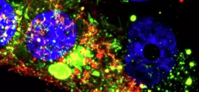 Microscopic image showing spherical, bright, fluorescent blue, purple, green, and red nasal epithelial cells infected with Respiratory Syncytial Virus (RSV). The cells are highlighted in various colors to indicate different cellular components and viral presence.
