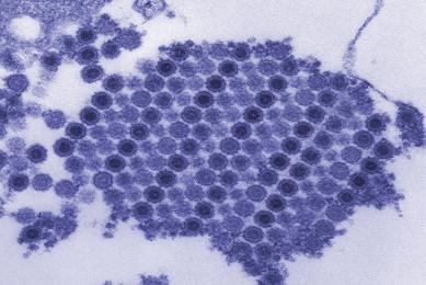 17550-digitally-colorized transmission electron micrograph (TEM) depicts numerous Chikungunya virus particles-Cynthia GoldsmithCDC.jpg