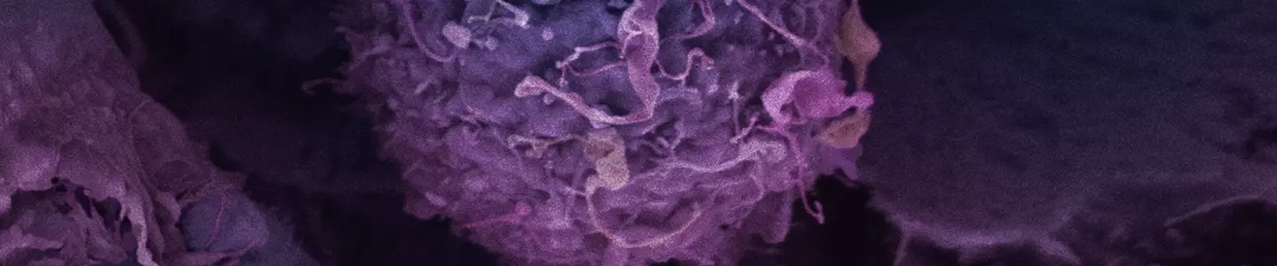 Colored scanning electron microscope image of a breast cancer cell with surface structures visible in detail.