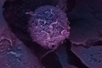 Colored scanning electron microscope image of a breast cancer cell with surface structures visible in detail.