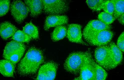Fluorescent green and blue adenocarciona mammary gland cells.