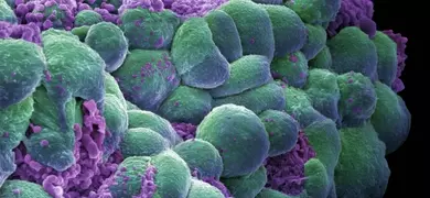 Breast cancer cells courtesy of Annie Cavanagh