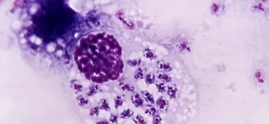 Purple and white clusters of a Trypanosoma cruzi parasitic infection.