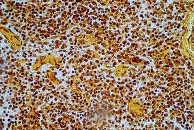 A histological microscopy image shows densely packed hepatocytes with brown immunohistochemical staining highlighting cytoplasmic structures, surrounded by numerous dark‑stained nuclei. The tissue displays an organized cellular pattern typical of liver parenchyma with areas of increased staining intensity.
