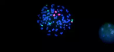 Fluorescent image showing chromosomes of a Non-Hodgkin lymphoblast mantle cell, with bright blue, green, and pink markers against a black background.