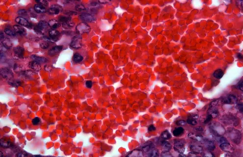 Red and purple tumor metastasis.