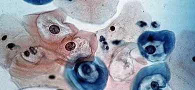 Microscopic image showing pink and blue human papillomavirus (HPV) spheres with dark circles in the middle, indicating the presence of viral particles within cells.