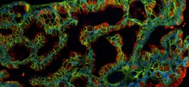 Fluorescent microscopy image of induced pluripotent stem (iPS) cells from an African American male, showing green and red staining to highlight cellular structures.