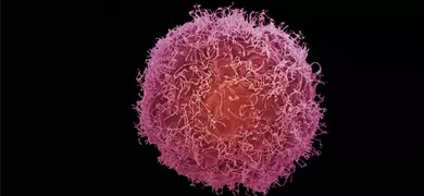 A highly magnified image of a skin cancer cell. The cell appears spherical with a rough, irregular surface texture and is colored in shades of pink and red against a black background.