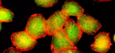 Fluorescent red and yellow-green adenocarciona mammary gland cells.