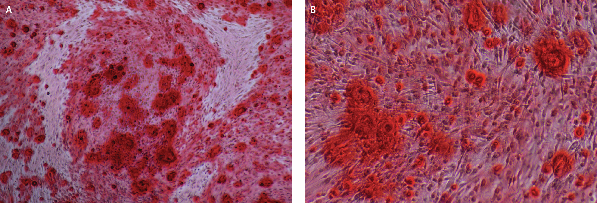 Microscopic images showing Alizarin Red staining of calcium deposits after osteogenic differentiation of DSCS cells: (A) 4X magnification of cell clusters with intense red staining and (B) 10X magnification revealing detailed red-stained calcium deposits within differentiated osteocytes.
