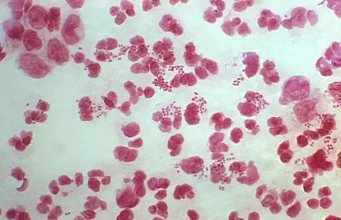 Red, large and small spherical shapes of Neisseria gonorrhoeae diplococci bacteria.