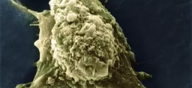 Metastasis melanoma cell with protrusion.
